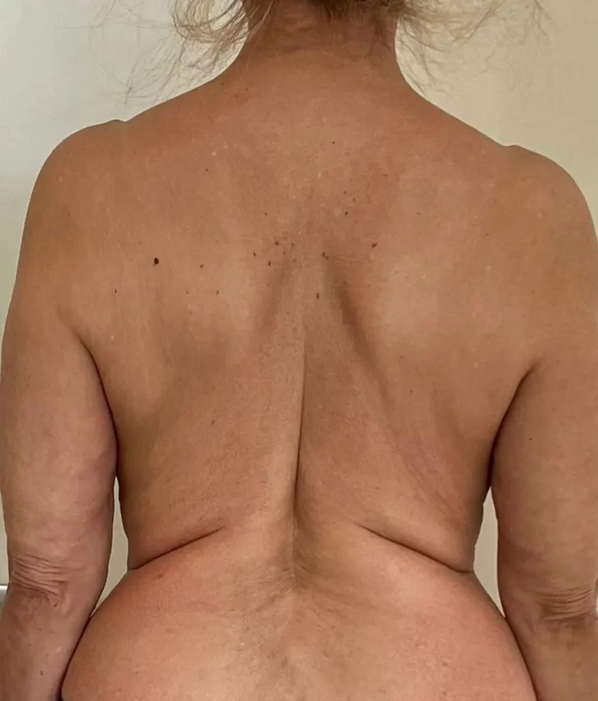 Transformational-Cupping-plaatje-1-na-de-behandeling